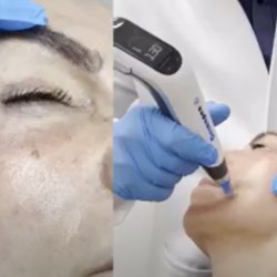 Reprodução | Dermapenworld